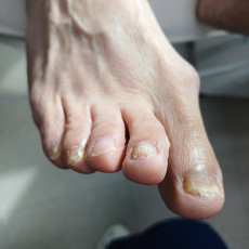 문제성 발톱 관리 받고 가세요~!