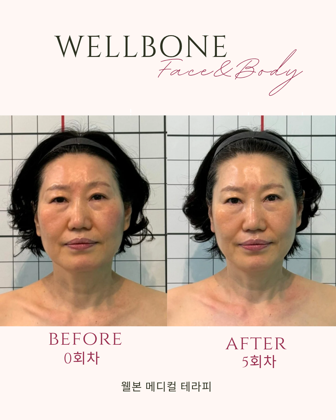 [서울/강남] 안면비대칭 윤곽관리 체험해보세요~!