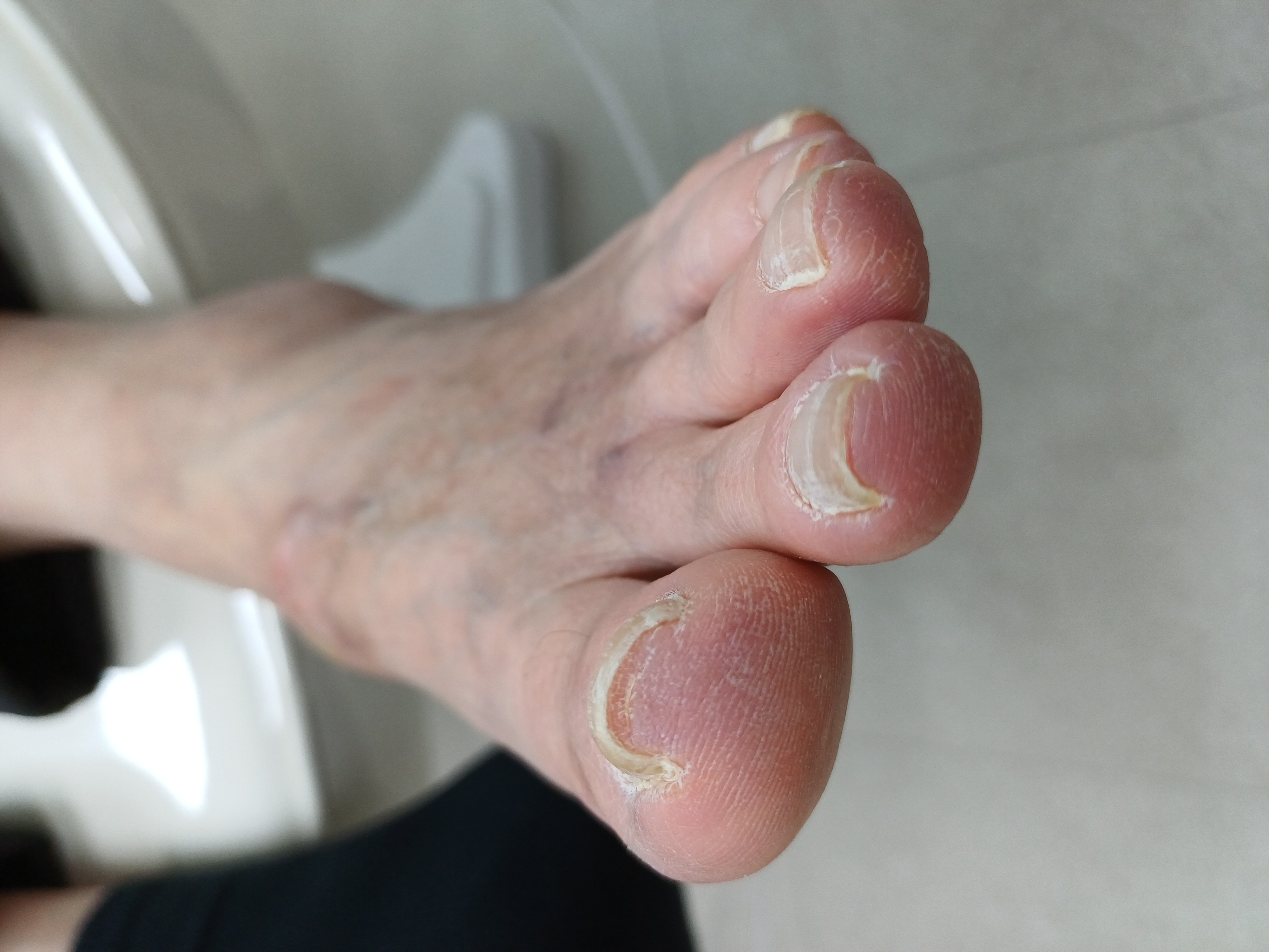 [경기/남양주] 문제성 발톱 관리 받고 가세요~!(대리체험가능)